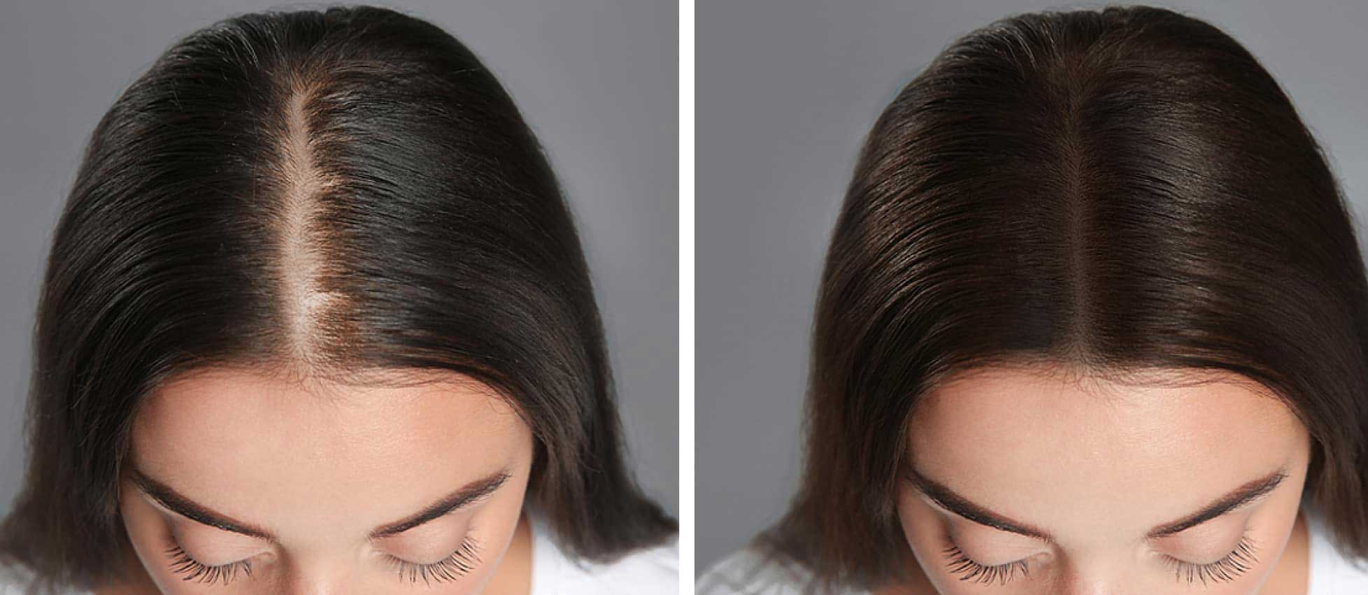 Hair Replacement in Irrum Manzil at New Look Hair Fixing