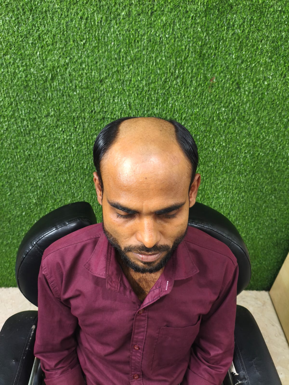 Hair coverage assessment at our Irrum Manzil hair fixing clinic