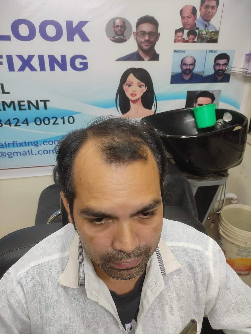 Professional hair patch fitting near Punjagutta Hyderabad