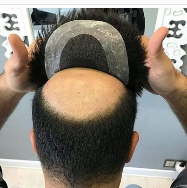 Professional hair system fitting in Irrum Manzil Hyderabad