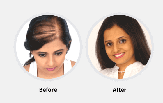 Hair Fixing in Irrum Manzil at New Look Hair Fixing